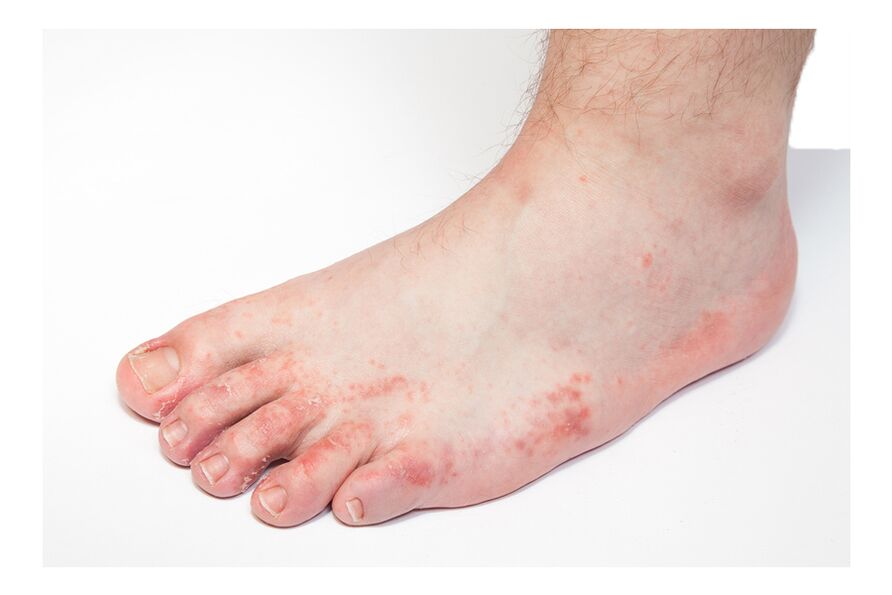 Mycosis of the feet and nails