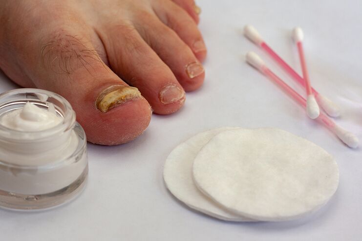 Fungus cream for toe fungus