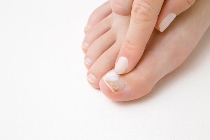 Fungus ointment to treat toes