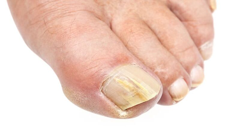 External changes of nails are a sign of fungal infection