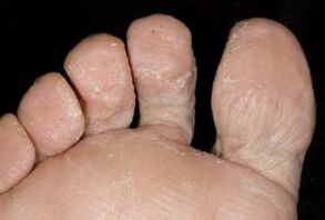 Symptoms of foot skin fungus