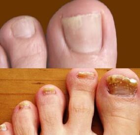 The initial and late stages of the fungus on the feet
