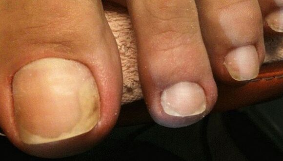 Early signs of toenail fungus