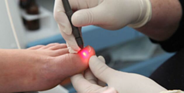 Laser treatment for toenail fungus