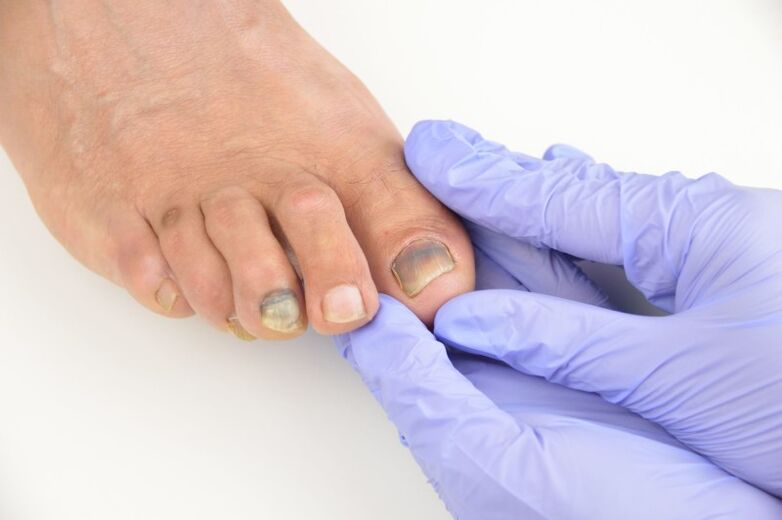Medical examination of toenails affected by fungus