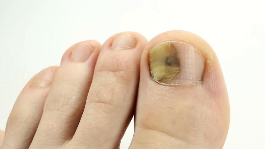The appearance of fungus-affected toenails