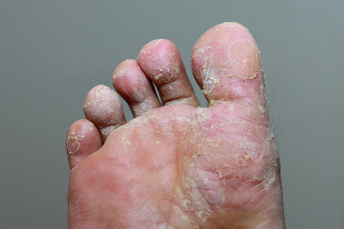 The heavy phase of mycosis of the skin of the toes